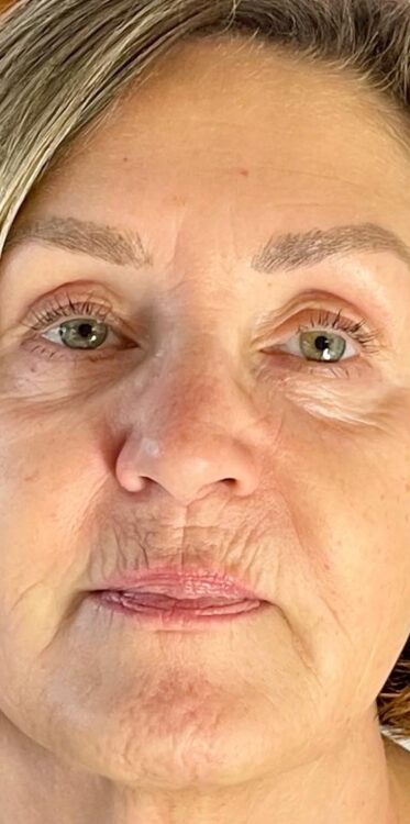 Collagen Lift Before & Afters - SkinBase™(Europe) Ltd