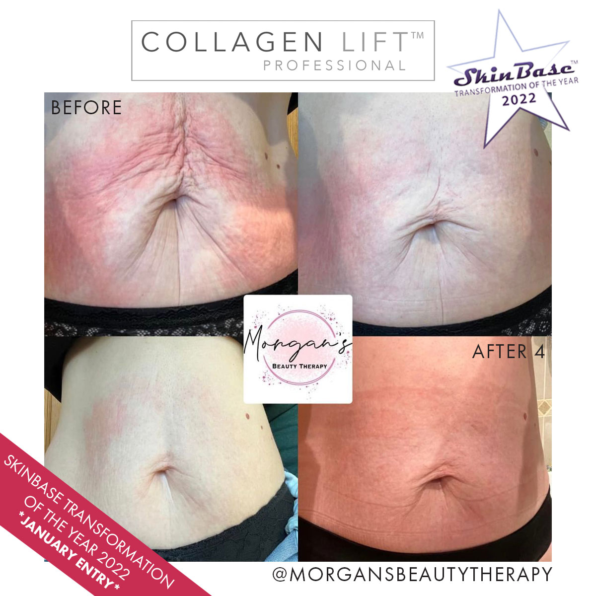 collagen lift summer prep