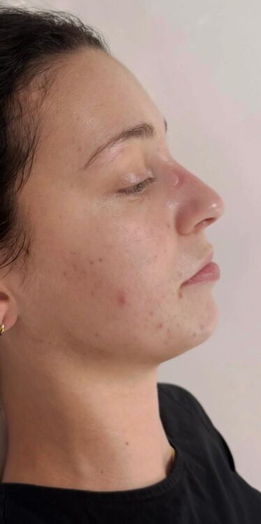 the best facial for acne prone skin skinbase hydro before and after January Katherine Monique Beauty