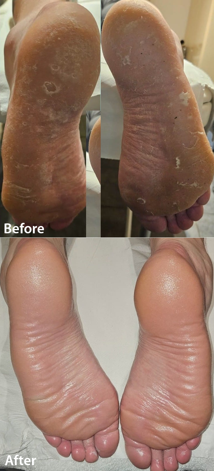 microdermabrasion pedicure