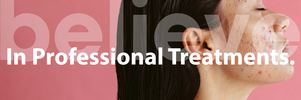 believe in professional treatment for acne 