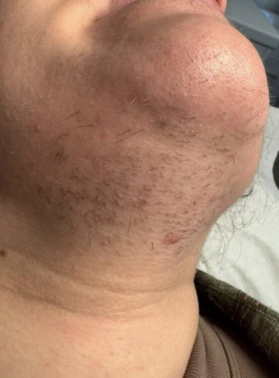 March-2026-Neo-Rebecca-IPL-treatment-for-unwanted-Hair-Chin-results-before