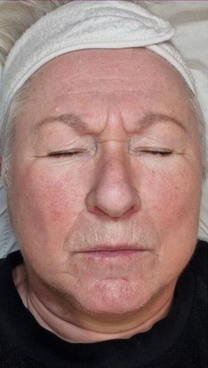 March 2026 Perry Walker Skincare Specialist Rosacea face treatment results non-surgical IPL vascular and photorejuvenation after