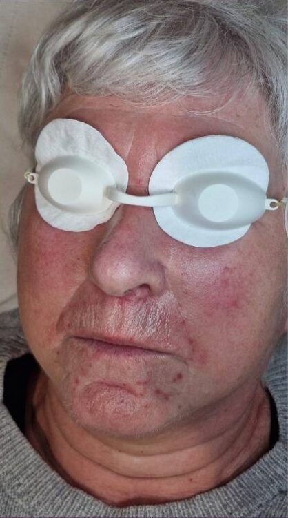 March 2026 Perry Walker Skincare Specialist Rosacea face treatment results non-surgical IPL vascular and photorejuvenation before
