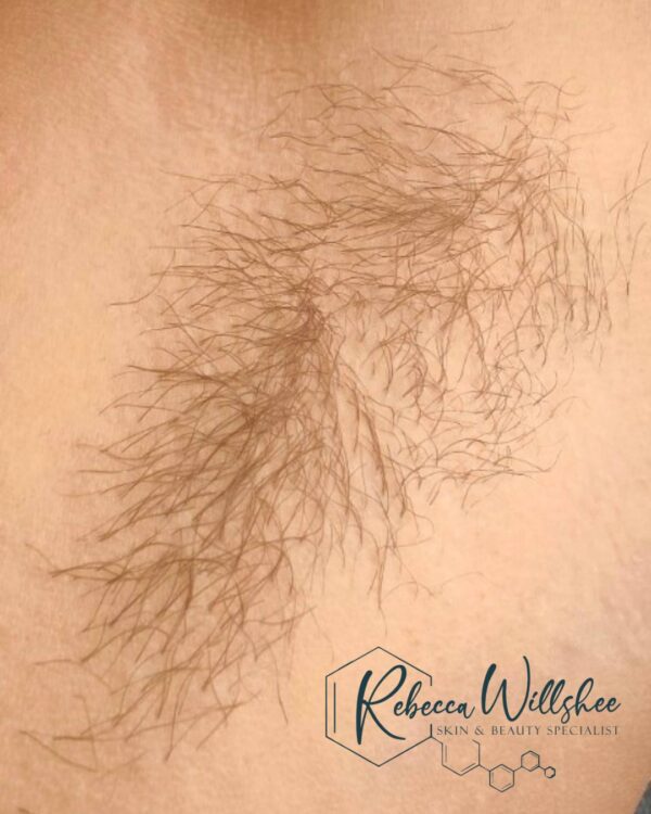March 2026 Rebecca Willshee unwanted underarm hair treatment IPL before