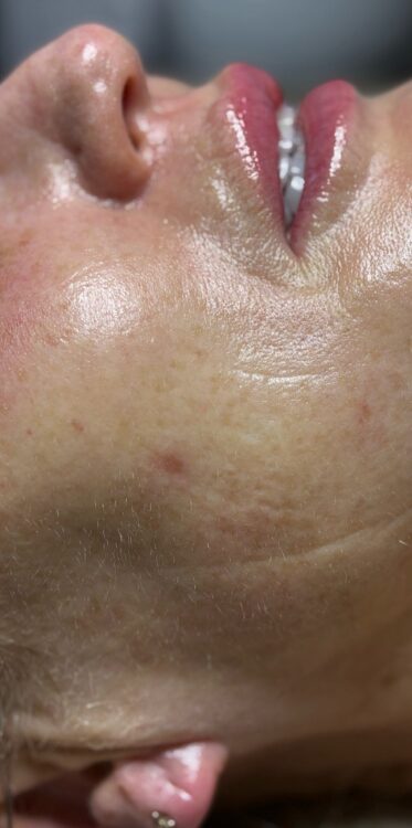 March-2026-Skin-Studio-Ormskirk-IPL-Hydro-Combination-for-Pigmented-Ageing-Skin-Non-Surgical-Treatment-Results-After