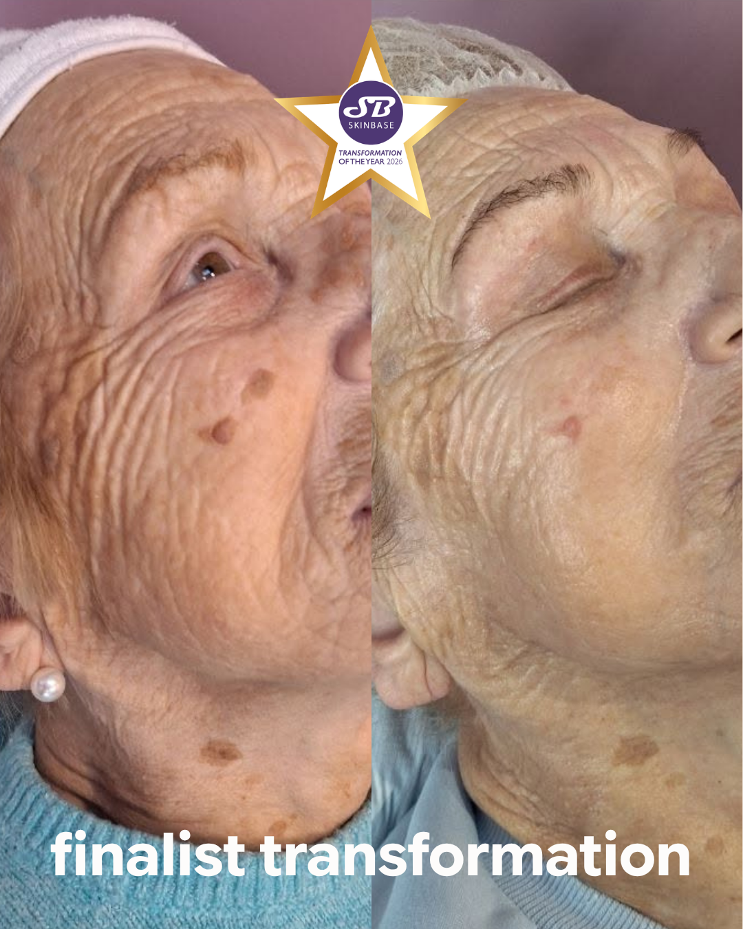 finalist-transformation-pink-beauty-collagen-lift-ageing-skin