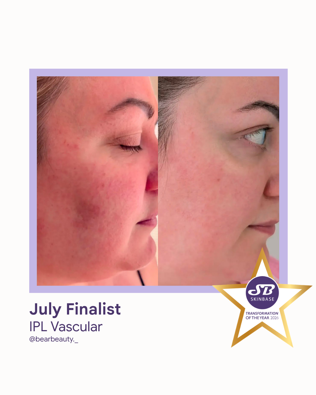 July 2026 Bear Beauty IPL Vascular