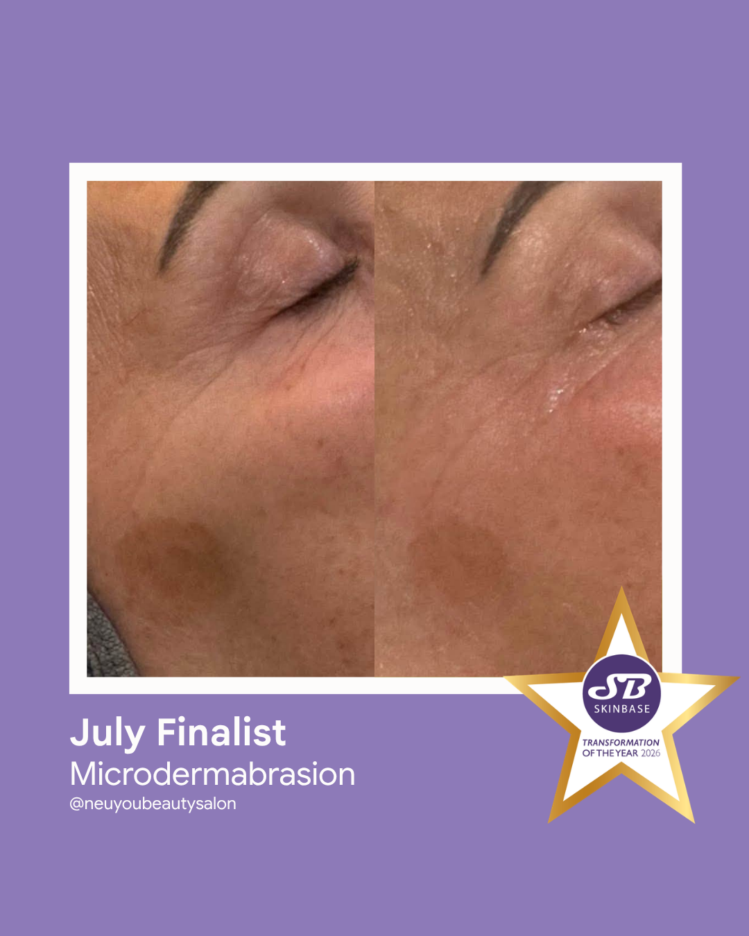 July 2026 Neu You Microdermabrasion -2