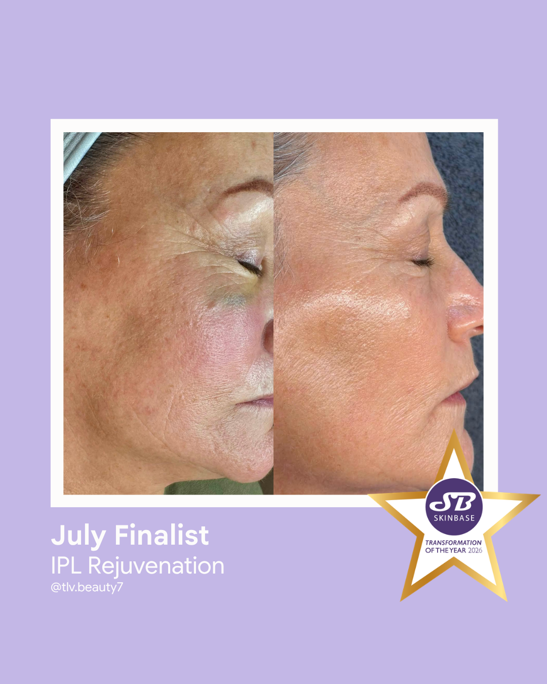 July 2026 TLV Beauty IPL 