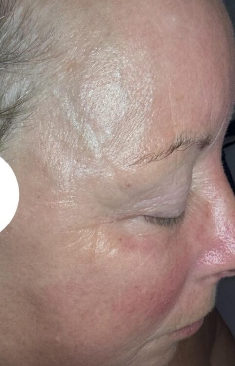 April 2026 Beauty Chic Microdermabrasion Facial for Ageing Skin After