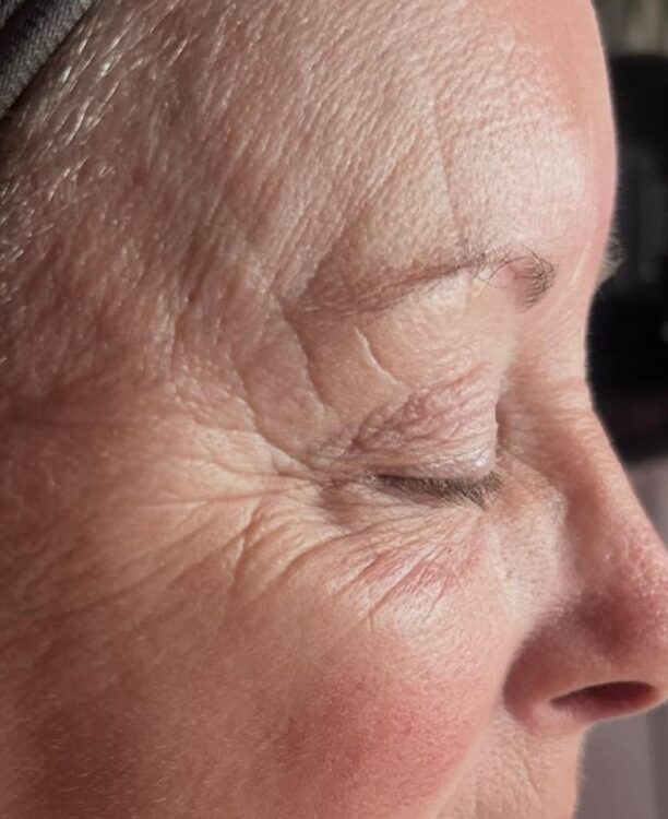 April 2026 Beauty Chic Microdermabrasion Facial for Ageing Skin Before