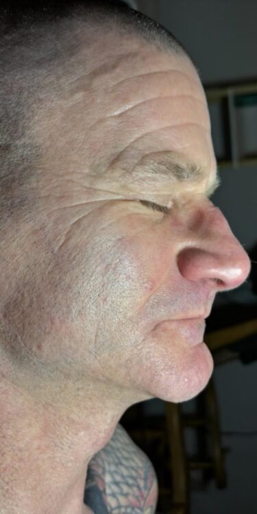 April 2026 DB Skin Therapy Microdermabrasion Facial for Ageing Skin Before