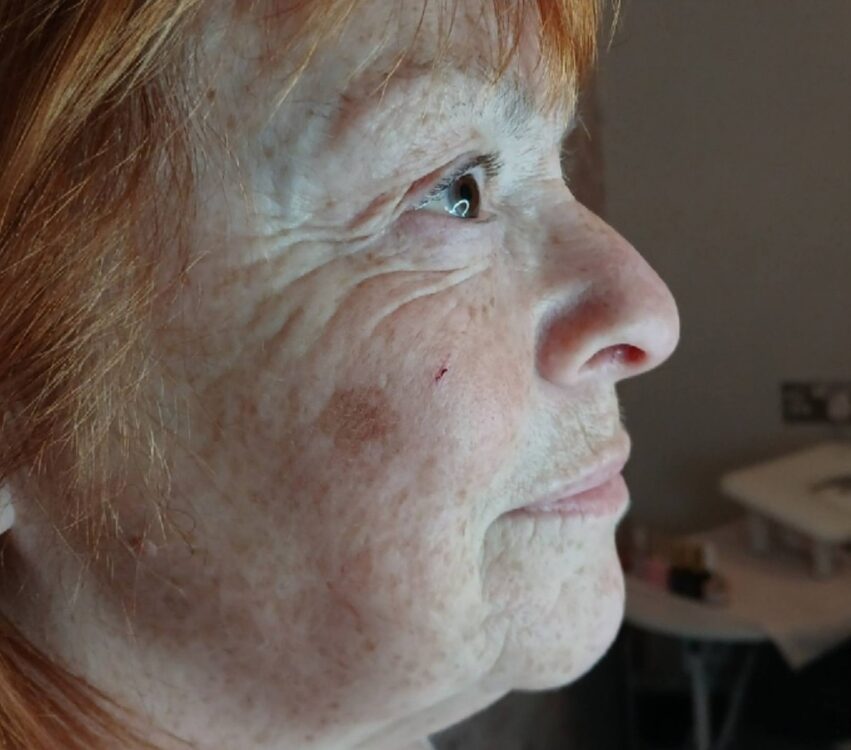 April 2026 Mel's Beauty Collagen Lift Facial for Ageing Skin Before