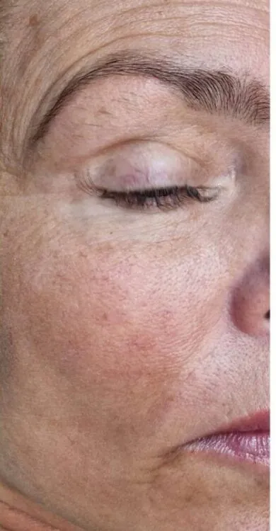 April 2026 Perry's Beauty IPL Vascular Facial for Thread Veins After