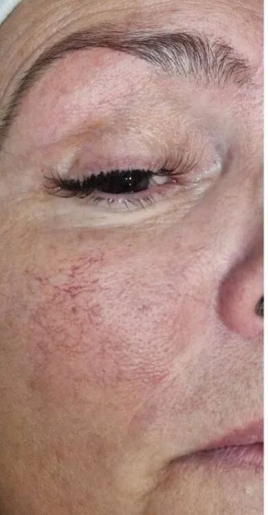 April 2026 Perry's Beauty IPL Vascular Facial for Thread Veins Before