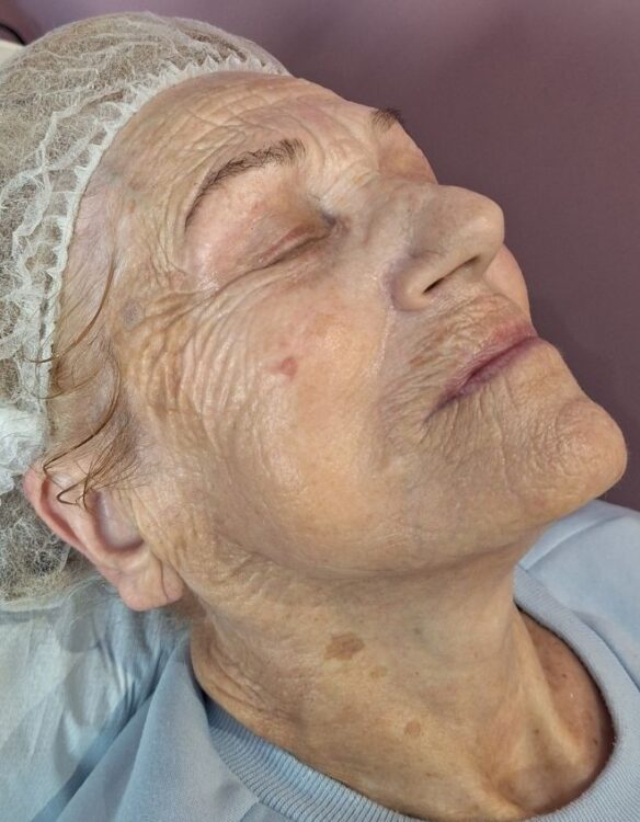 April 2026 Pink Beauty Collagen Lift Facial for Ageing Skin After