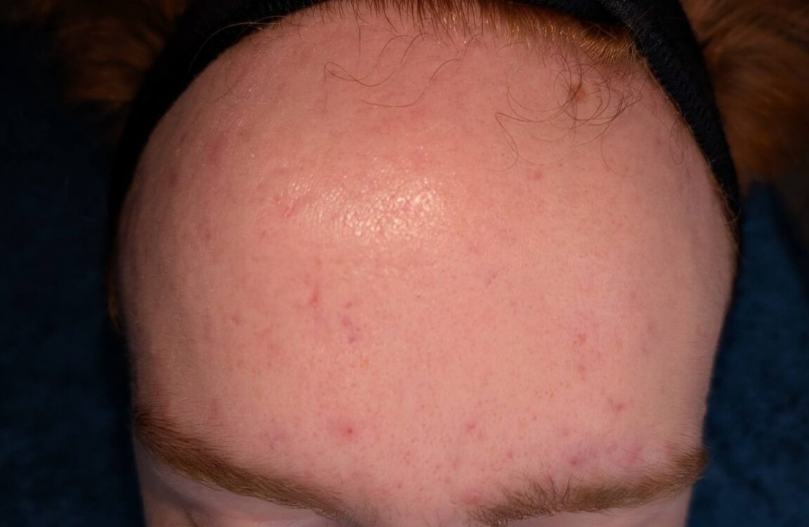 April 2026 Rebecca Willshee Skin and Beauty Specialist Hydro Facial for Acne After