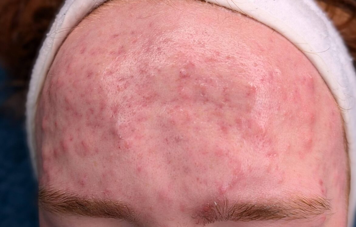 April 2026 Rebecca Willshee Skin and Beauty Specialist Hydro Facial for Acne Before