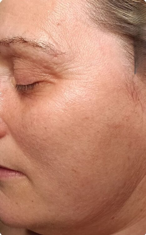 April 2026 Refined Beauty Microdermabrasion Facial for Milia After
