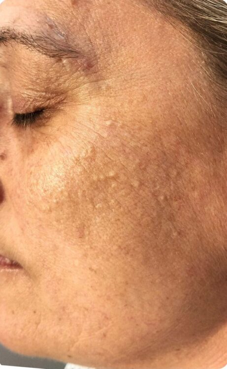 April 2026 Refined Beauty Microdermabrasion Facial for Milia Before