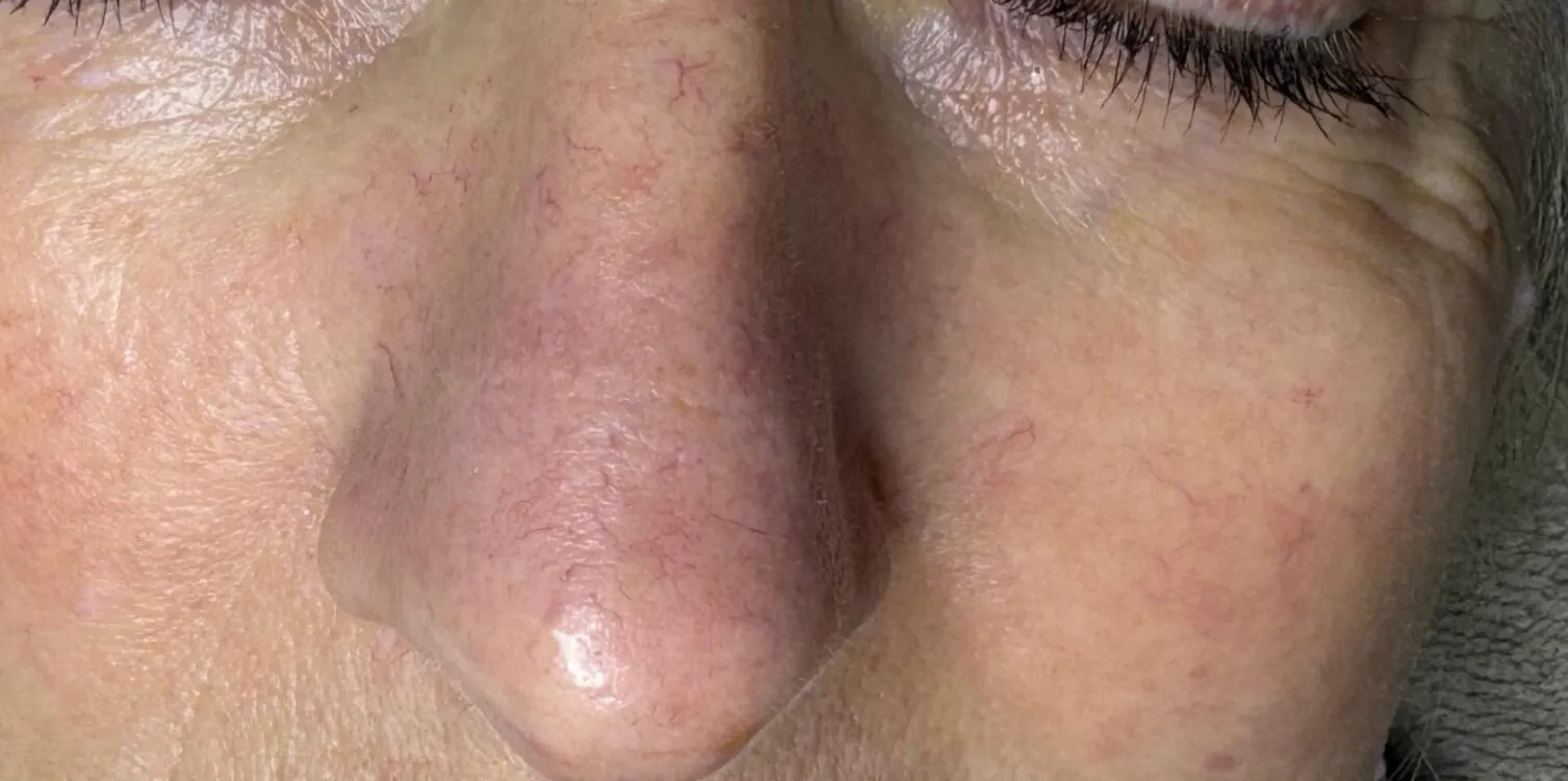 April-2026-Skin-Studio-IPL-Vascular-Facial-for-Thread-Veins-after