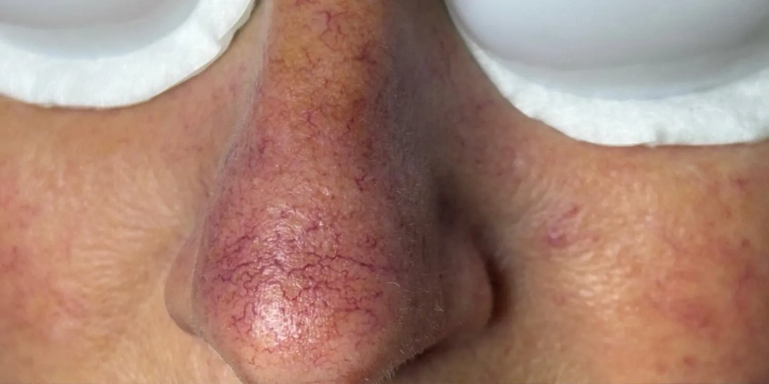 April-2026-Skin-Studio-IPL-Vascular-Facial-for-Thread-Veins-Before