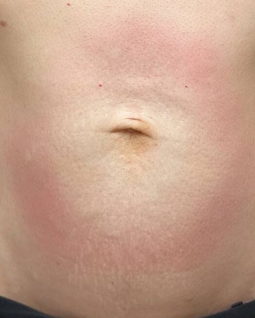 April 2026 The Beauty Barn Pinwall Collagen Lift on Tummy for Sagging Skin After