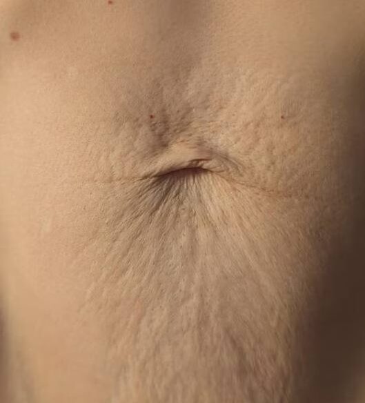 April 2026 The Beauty Barn Pinwall Collagen Lift on Tummy for Sagging Skin Before