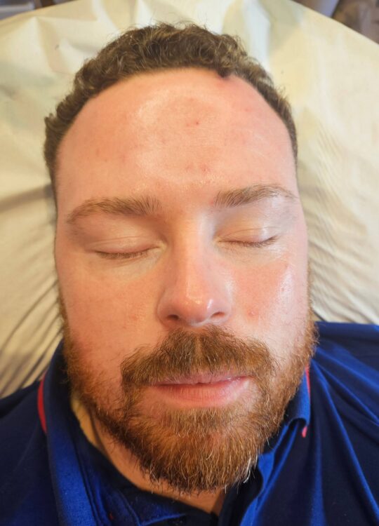 April 2026 The Beauty Room Microdermabrasion Facial for Acne After