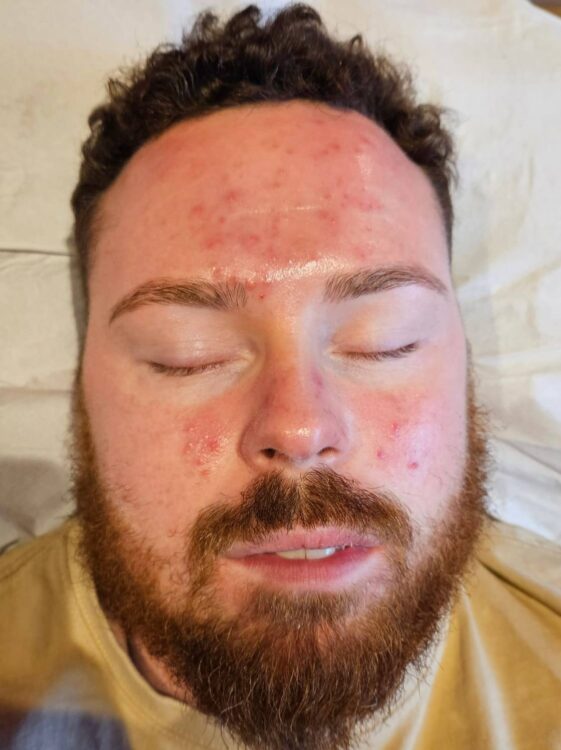 April 2026 The Beauty Room Microdermabrasion Facial for Acne Before