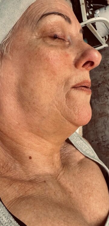 April 2026 The Body Bar Collagen Lift Facial for Ageing Skin Before