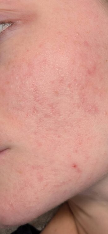 August 2026 Bear Beauty Hydro IPL Facial for Acne After