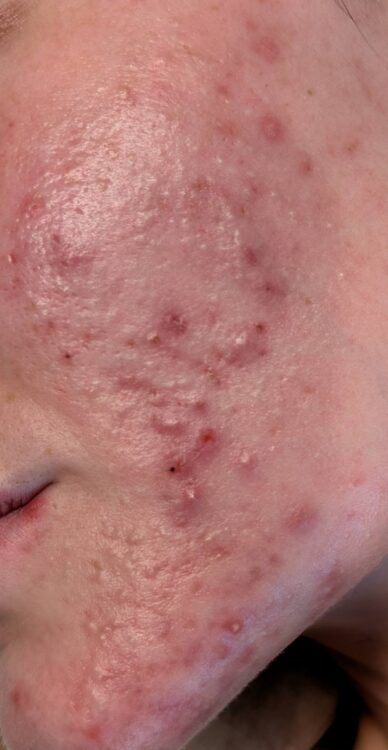 August 2026 Bear Beauty Hydro IPL Facial for Acne Before