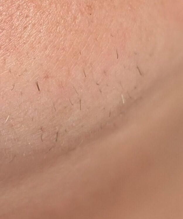 August 2026 Bear Beauty IPL Hair Reduction on Chin After