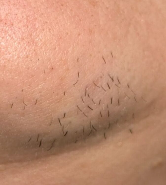 August 2026 Bear Beauty IPL Hair Reduction on Chin Before