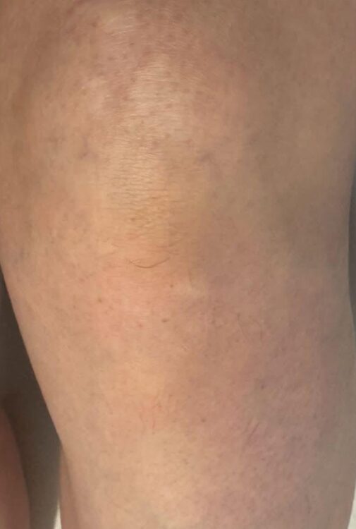 August 2026 Head to Toe Baillieston IPL Hair Reduction on Legs After