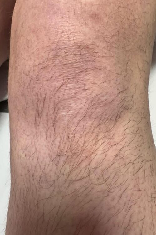 August 2026 Head to Toe Baillieston IPL Hair Reduction on Legs Before