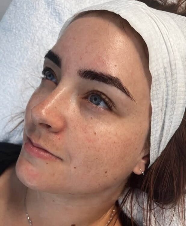 August 2026 Helen Eustace Aesthetics Microdermabrasion Hydro Facial for Textured Skin After