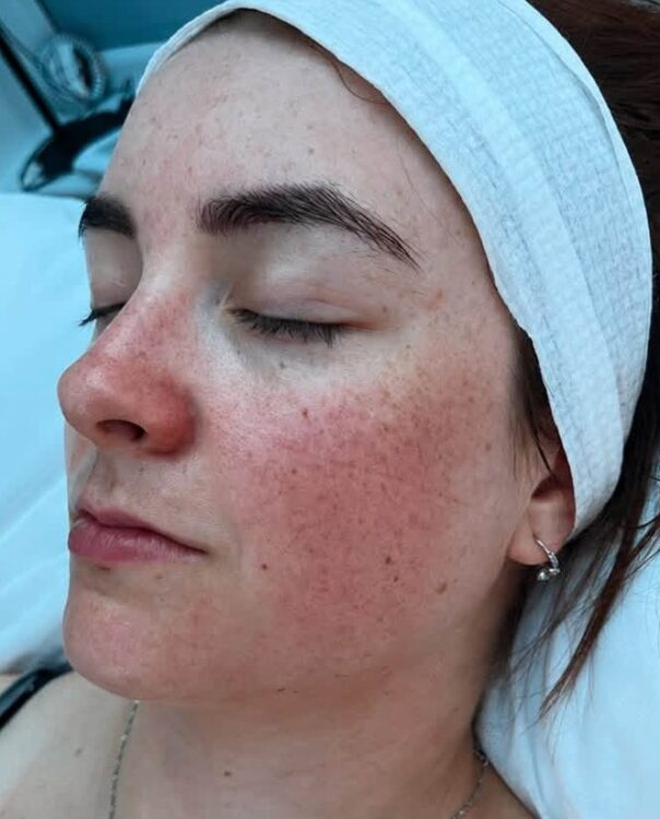 August 2026 Helen Eustace Aesthetics Microdermabrasion Hydro Facial for Textured Skin Before