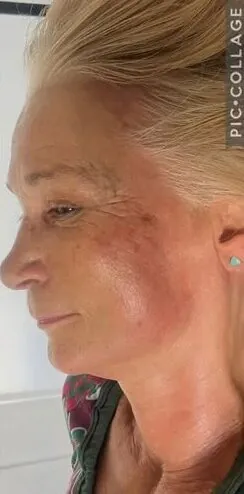 August 2026 LH Aesthetics Skincare Specialist Collagen Lift Facial for Ageing Skin After