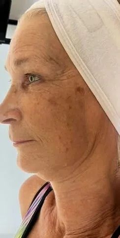 August 2026 LH Aesthetics Skincare Specialist Collagen Lift Facial for Ageing Skin Before