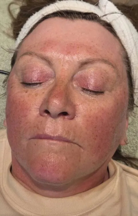 August 2026 Skinoveve Collagen Lift Facial for Ageing Skin After