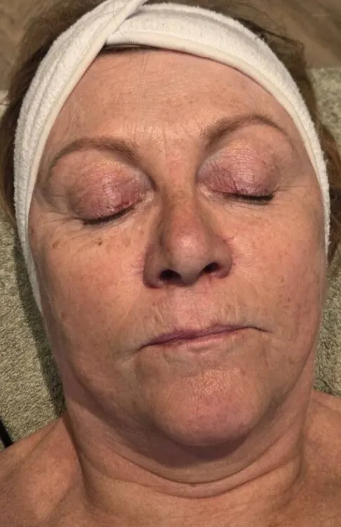 August 2026 Skinoveve Collagen Lift Facial for Ageing Skin Before