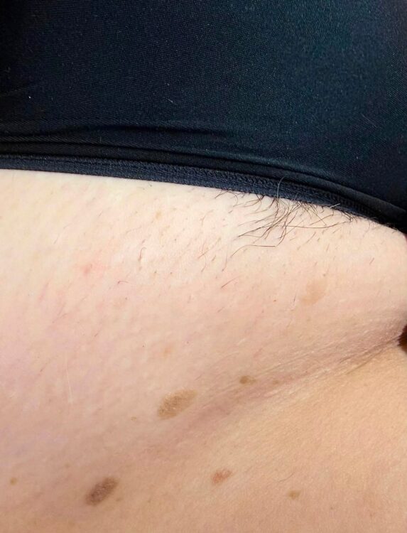 August 2026 TLV Beauty IPL Hair Reduction on Bikini After