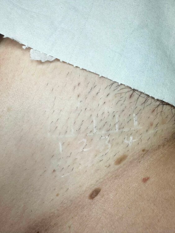 August 2026 TLV Beauty IPL Hair Reduction on Bikini Before