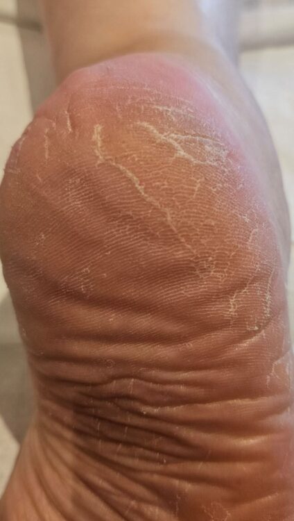 August 2026 The Beauty Room Laura Peace Microdermabrasion Pedicure Before