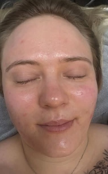 August-2026-Tranquil-Essence-Hydro-Microdermabrasion-Facial-for-Acne-After
