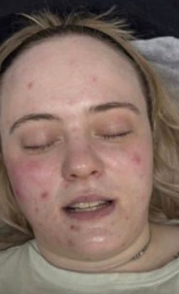 August-2026-Tranquil-Essence-Hydro-Microdermabrasion-Facial-for-Acne-Before
