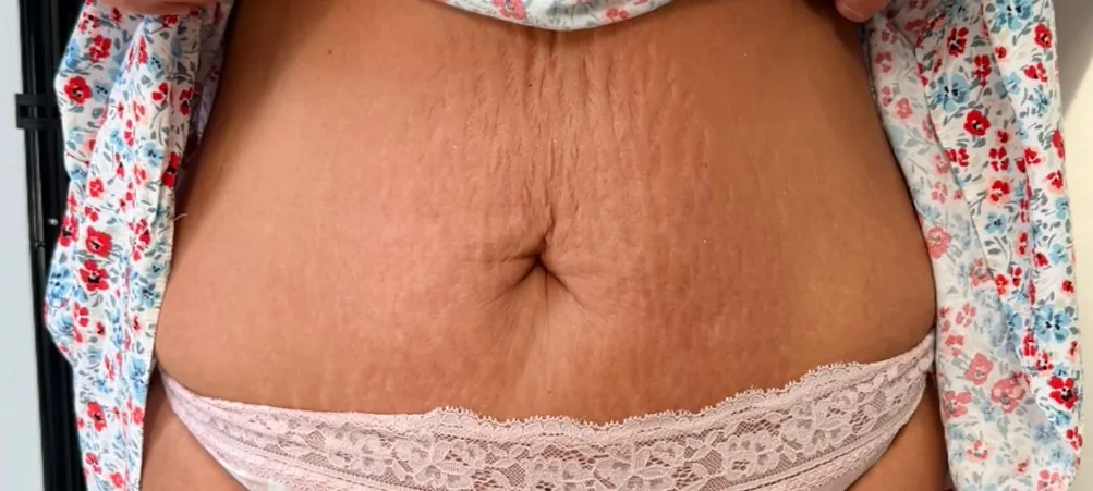 August 2026 You Aesthetics Staffordshire Ltd Collagen Lift on Tummy for Sagging Skin After